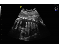 Hydrothorax coronal bilateral